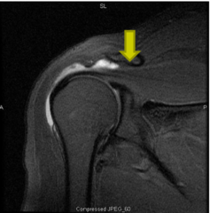<p>-Acute or subacute pain after overuse or trauma; diffuse lateral shoulder pain</p><p>-Pain with passive ROM and palpation of subacromial area; often pain throughout motion, not just arc; weakness due to pain inhibition, not tendon tear</p>