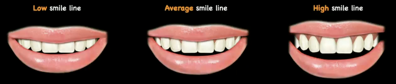 <p>rank low, average, and high smile line from most to least common in the population </p>