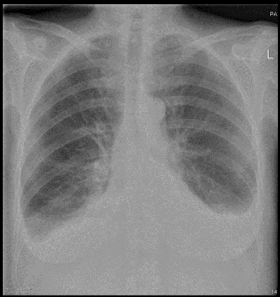 <p><span>Female. 85 years. Previously well. Now attends her General Practitioner c/o increasing shortness of breath.</span><br><span>Temperature normal</span></p>