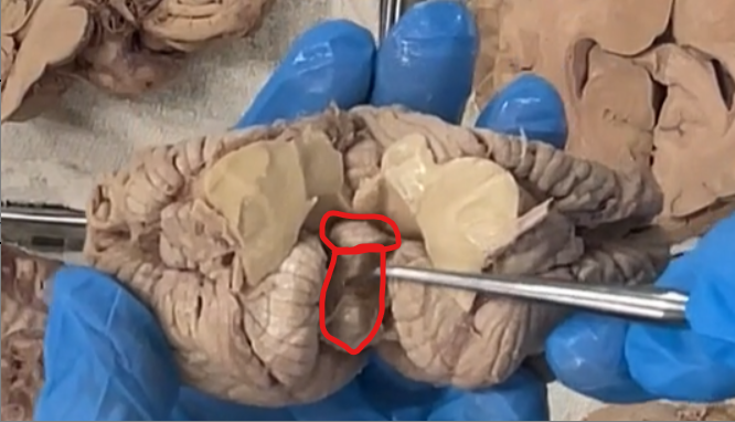 <ol><li><p>spread the tonsils</p></li><li><p>superior small circle: nodule</p></li><li><p>inferior large circle: uvula</p></li></ol><p>These are features of the inferior vermis. </p>