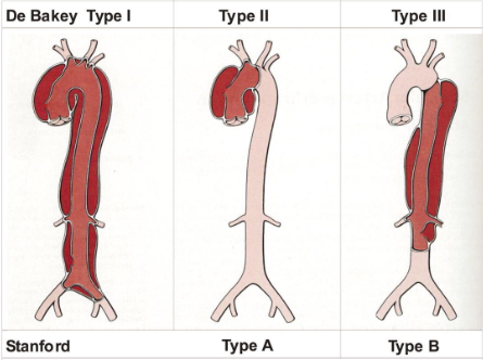 <ul><li><p><strong>DeBakey:</strong></p><ul><li><p>Type I: originates in the proximal ascending aorta. Involves ascending aorta, arch, and variable lengths of descending and abdominal aorta</p></li><li><p>Type II: ascending aorta only</p></li><li><p>Type III: begins in the descending aorta</p></li></ul></li><li><p><strong>Standard:</strong></p><ul><li><p>Type A: any dissection that involves ascending aorta</p></li><li><p>Type B: any dissection that does not involve ascending aorta</p></li></ul></li></ul><p></p>