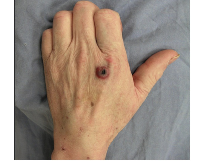 <p><span>Identify the following disease based upon the physical manifestation</span></p><p></p>
