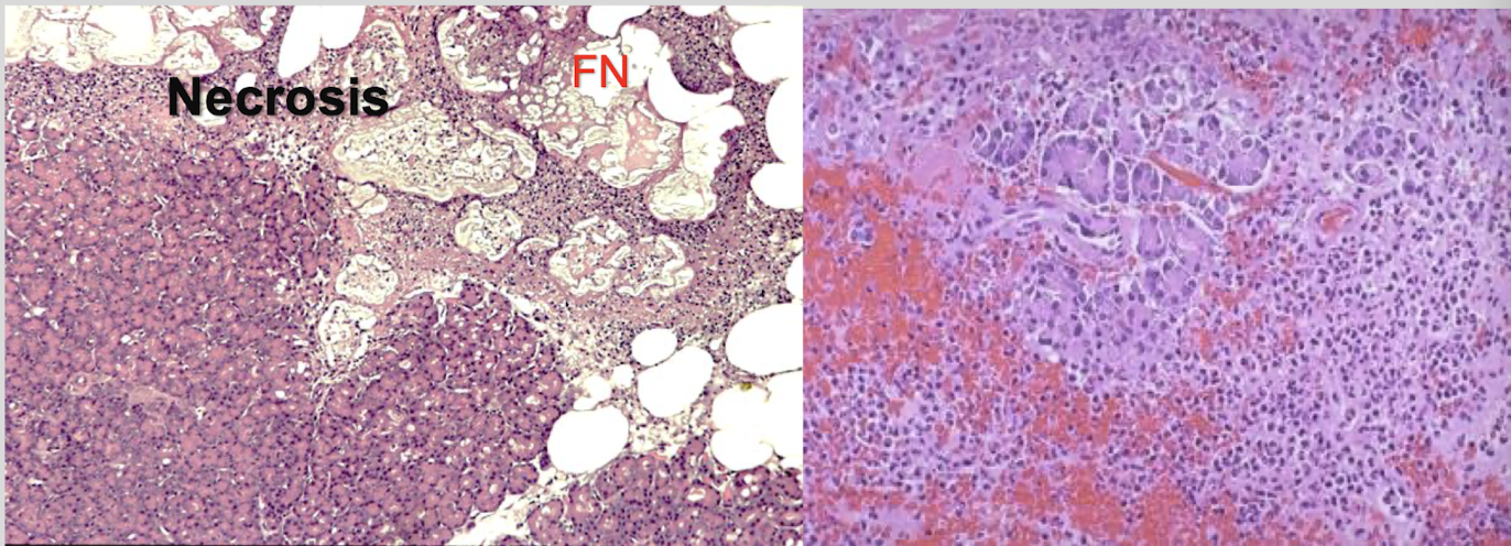<p><strong>calicum deposits</strong> in saponified fats → peripancreatic fat necrosis</p>