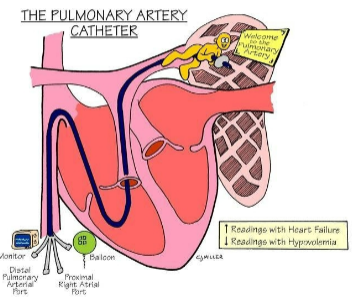 <p>put into right IJ, goes thru right atrium, right ventricle, ends in pulm artery</p><p>also measures pressure in blood flow</p><p><u>normal:</u> 15-26 mm Hg / 5-15 mm Hg</p><p><u>if high:</u> heart failure</p><p><u>if low:</u> hypovolemia</p><ul><li><p><u>pulm capillary wedge pressure (PCWP):</u> estimates pressure of left atria</p><ul><li><p>can’t inflate balloon more than 1.5mL</p></li><li><p><u>normal:</u> 6-12 mm Hg</p></li><li><p><u>if high:</u> heart failure</p></li><li><p><u>if low:</u> hypovolemia</p></li></ul></li></ul><p></p>