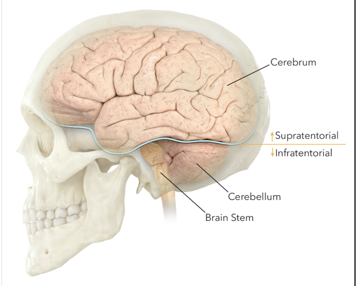 <ul><li><p>infratentorially (cerebellum &amp; brainstem)</p></li></ul><p></p>