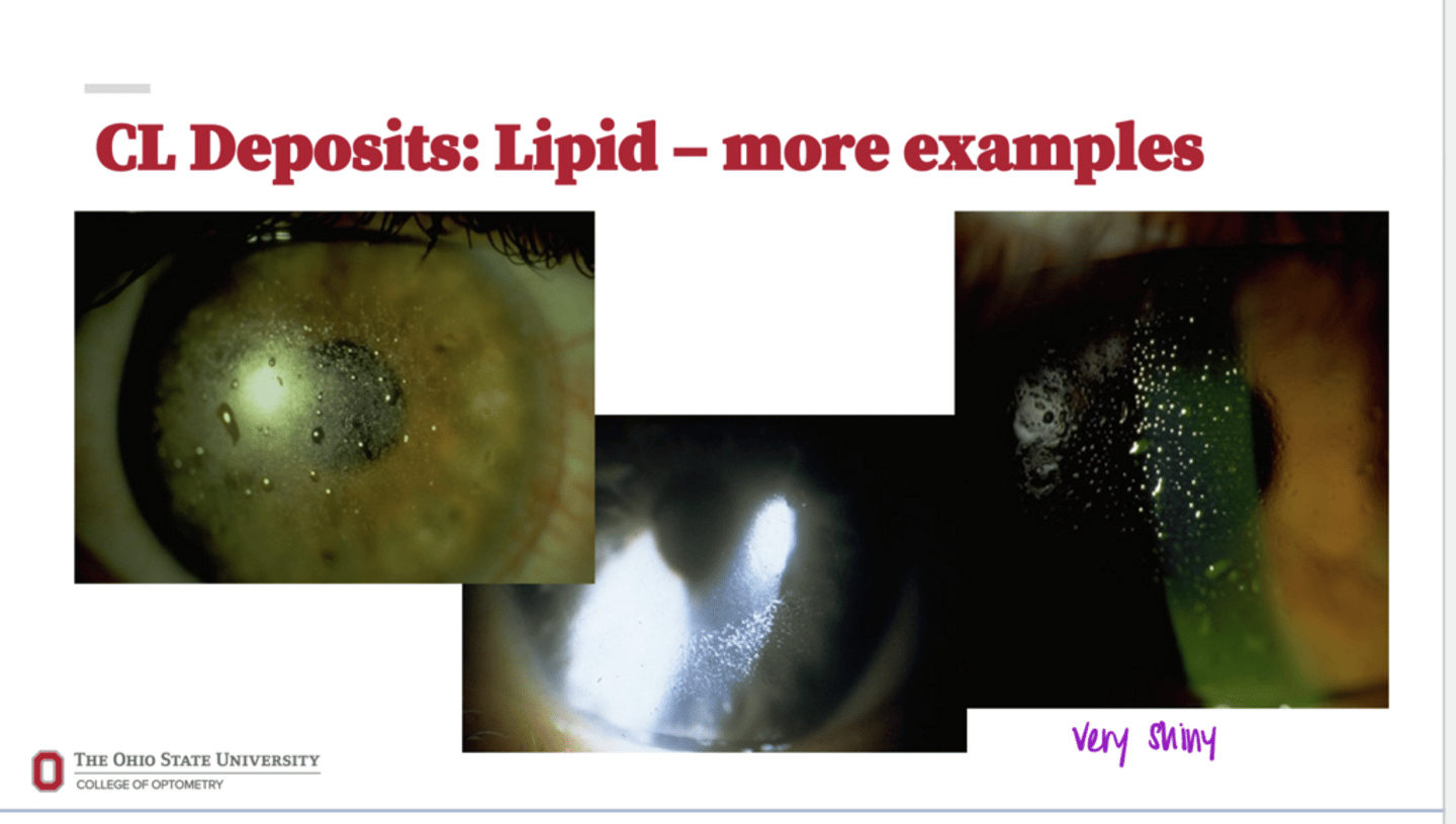 <p>CL Deposits -- Lipids (Pic)</p>