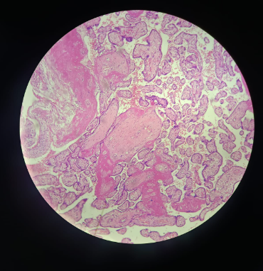 <p>Placenta - HE</p><ul><li><p>chorionic villi goes inside the endometrium</p></li><li><p>placenta is formed by the maternal and the fecal parts</p></li><li><p>placenta is normally formed in the endometrium of the mother</p></li><li><p>Structure of villi:</p><ul><li><p>2 layers of cells surrounding the embryonic part</p></li><li><p>cytotrophoblast (inside)</p></li><li><p>syncytiotrophoblast (outside)</p></li><li><p>with time, cytotrophoblast will disappear and left with syncytiotrophoblast</p></li></ul></li><li><p>Chorion villi has a lot of blood vessels, because placenta helps get nutrition and oxygen from mother to babies</p></li><li><p>these two tissues never mix</p></li><li><p>mucous embryonic connective tissue - built of collagen type 1 small fibers and round cells, very limited amount of ground substance</p></li></ul><p></p>
