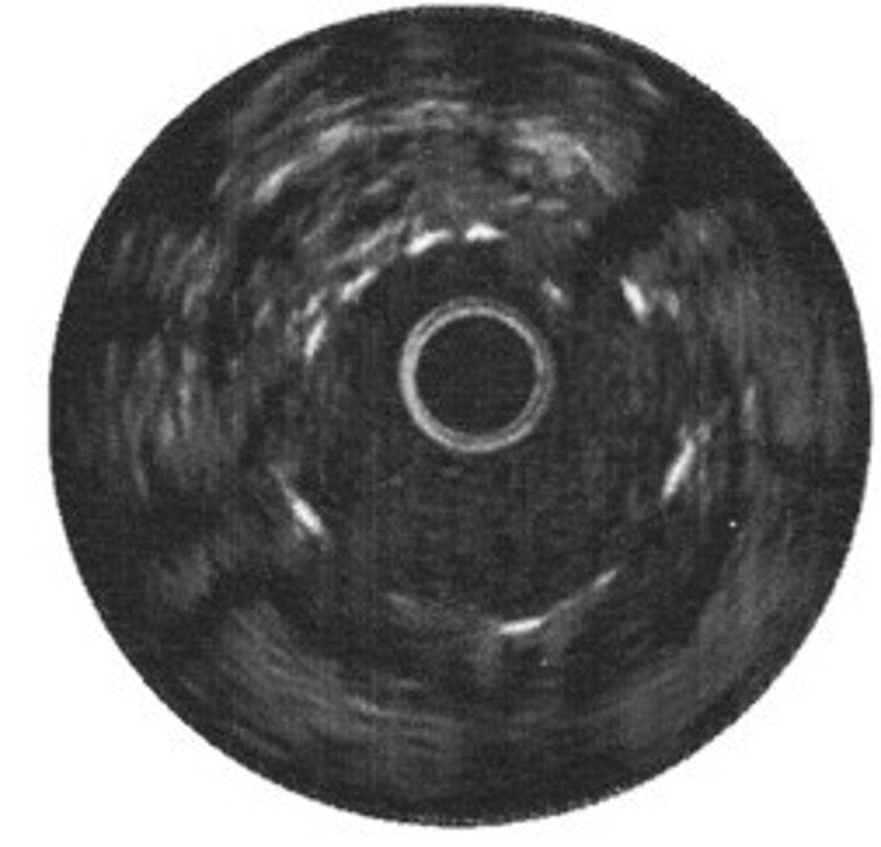 <p>This stent is not fully apposed</p>
