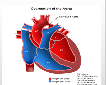 <p><mark data-color="blue" style="background-color: blue; color: inherit;">-localized narrowing of the aorta, typically at the level of the ductus arteriosus</mark></p><p>-increased pressures to the head and upper extremities, decreased pressure to the lower extremities</p><p>-bounding upper pulses, lower or absent lower pulses. <mark data-color="blue" style="background-color: blue; color: inherit;">CHECK FEMORAL PULSES</mark></p><p>-high BP of arms, low BP of legs, cool limbs, headache, dizziness, fainting, epistaxis</p><p>-if undiagnosed, we fear <strong><mark data-color="blue" style="background-color: blue; color: inherit;">RUPTURED AORTA</mark></strong></p><p>-surgical repair before 6mo</p><p>-resection of the narrowed portion, followed by end-to-end reanastomosis</p>