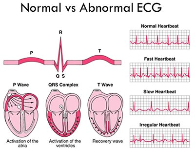 <ul><li><p>A test that records the electrical activity of the heart to check for abnormal heart rhythms and other heart problems.</p><ul><li><p>such as myocardial ischemia and infarction, heart damage, rhythm and conduction disturbances, chamber enlargement, electrolyte imbalances, and drug toxicity.</p></li></ul></li></ul><p></p>