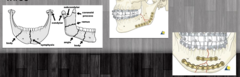 <p>- Requires OMFS consultation</p><p>- Prophylactic antibiotics suggested (bc oral bacteria)</p><p>- Surgery requires ORIF mandible with plates and/or wires (2 screws above, 2 screws below, and not through)</p>