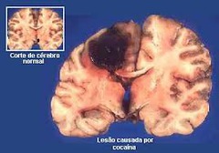 <p>tissue destruction. A brain lesion is a naturally or experimentally caused destruction of brain tissue.</p>