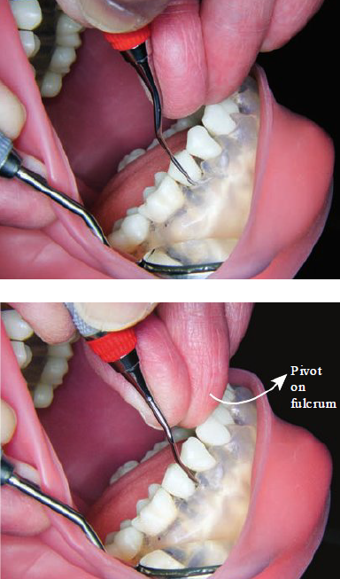 <ul><li><p>Ring (fulcrum) finger acts as a pivot as the hand turns during instrumentation </p></li><li><p>Keeps working end against tooth </p></li></ul><p></p><p><strong>Before pivoting </strong></p><ul><li><p>Clinician is moving working end across facial surface of second premolar </p></li><li><p>Only underside of middle finger is visible in photo</p></li></ul><p></p><p><strong>After pivoting </strong></p><ul><li><p>Clinician reaches mseiofacial line angle </p></li><li><p>She pivots fulcrum finger to rotate hand slightly</p></li><li><p>Working end moves from facial surface to mesial surface of premolar</p></li><li><p>Side of middle finger is visible after hand pivot</p></li></ul><p></p>