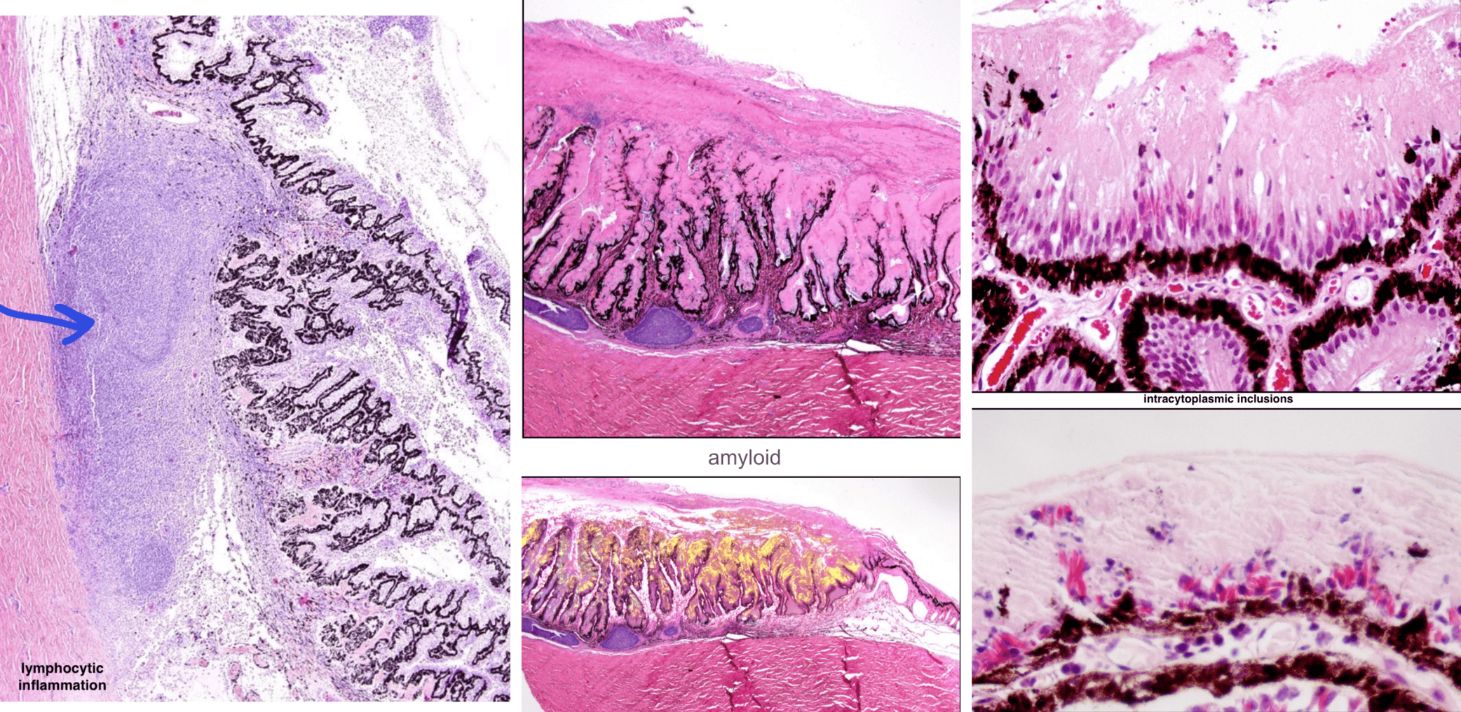 <ul><li><p>lymphocytic inflammation in the uvea, sometimes follicular</p></li><li><p>eosinophilic (hyalinized) membrane coats the ciliary processes — amyloid</p></li><li><p>intracytoplasmic inclusions in non-pigmented ciliary body epithelium</p></li></ul><p></p>