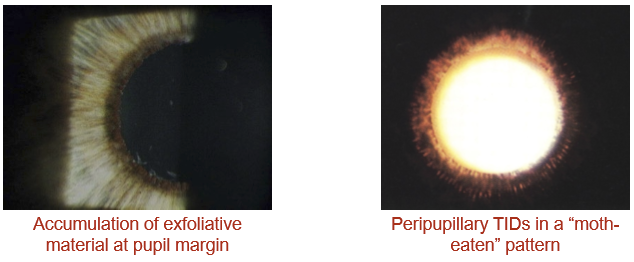 <ul><li><p>PDS: radial midperipheral iris transillumination defects</p></li><li><p>PXF: peripupillary “moth-eaten” transillumination defects</p></li></ul><p></p>