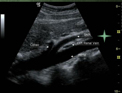 <p>Name 2 kidney characteristics evaluated in the direct method.<br>→ Size and morphology/echogenicity</p><p>Why is the aorta evaluated during direct renal duplex?<br>→ Evaluate for aortic disease</p><p>What aortic Doppler value is obtained?<br>→ Mid-aortic PSV</p><p>^why do we do that what ratio are we trying to get?<br>→ Used for renal artery – aorta ration (RAR)</p>