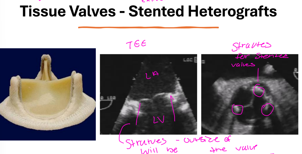 <p>• Made of tissue and do not click</p><p>• Normal and abnormal opening and closing sounds</p><p>similar to native valves</p><p>• Aortic position - have a systolic ejection murmur</p><p>• Mitral position - have a early-mid systolic ejection</p><p>murmur attributable to turbulent flow in the LVOT</p><p>• Ejection murmur is followed by second heart</p><p>sound and then valve opening</p><p>• Low flow diastolic rumble maybe heard at the</p><p>apex</p>