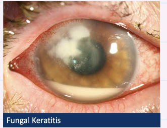 <ul><li><p>Epiphora</p></li><li><p>Discharge → mucopurulent ot purulent </p></li><li><p>Conjunctival hyperaemia </p></li><li><p>corneal lesion → single (central or mid-peripheral)</p></li><li><p>ulcer</p></li><li><p>stromal infiltration &amp;oedema → folds in descemets membrane </p></li><li><p>Hypopyon </p></li><li><p>Flare and cells in anterior chamber </p></li></ul><p></p>