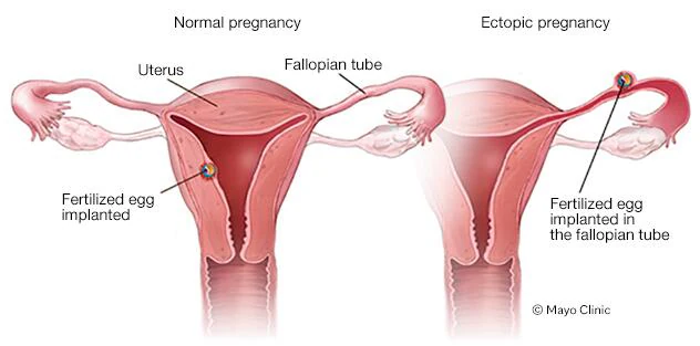<p><span>pregnancy implanted anywhere outside of the uterus (most common uterine tube, least common abdominal cavity) </span><br><span>*EMERGENCY b/c uterine tube cannot sustain tremendous expansion like the uterus</span></p>