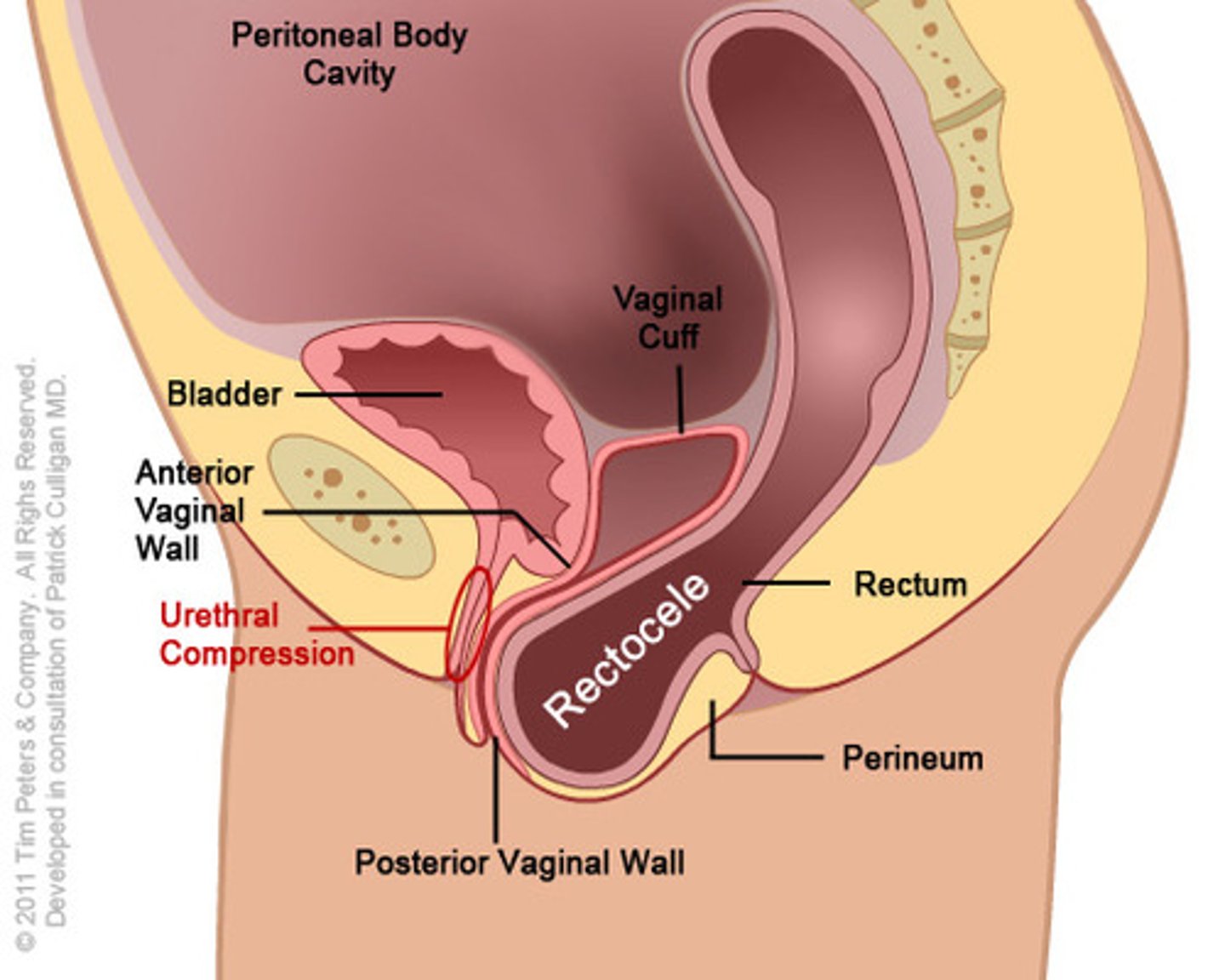 <p>rectocele</p>