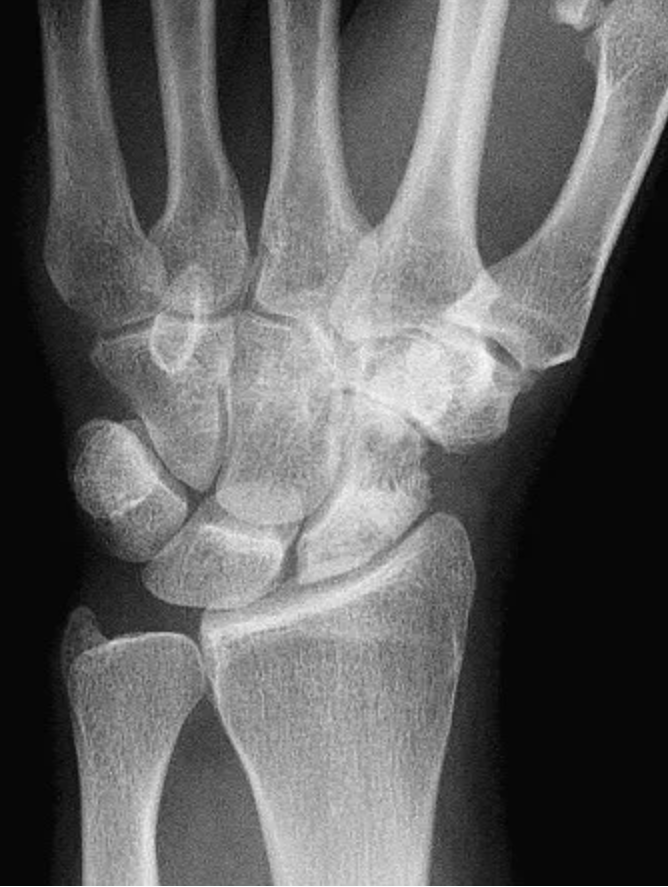 <p>AVN at carpal scaphoid </p>
