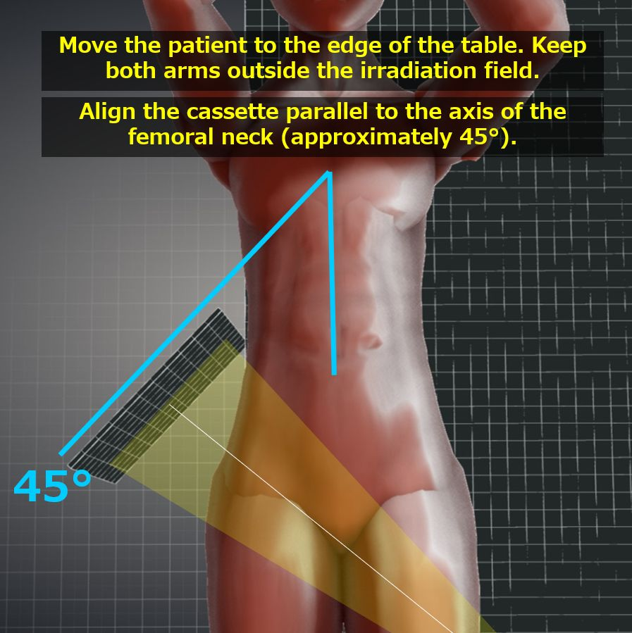 <p>Clements Nakayama if both hips are affected.</p><ul><li><p>Use upright bucky.</p></li><li><p>Turn patient 45 degrees to show femoral neck.</p></li><li><p>CR 20 degrees inferiorly from horizontal</p></li><li><p>Make sure the patient is at the edge of the bed and close to the detector</p><p></p></li></ul><p></p>