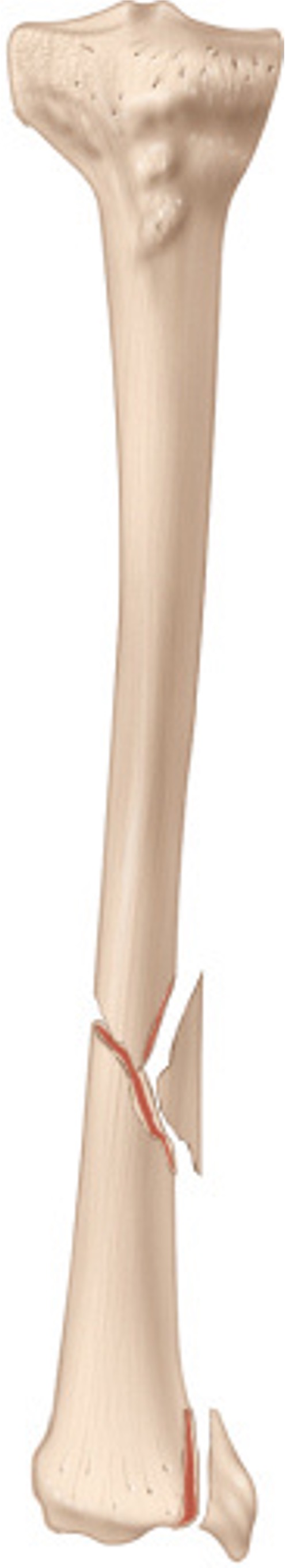 <p>MULTIPLE fracture lines and bone pieces</p>