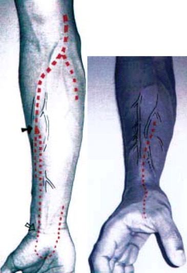 <p>Site: Artery ( to break up clot) can't administered</p><p></p>