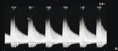 <p>The Doppler sample volume in this image is most likely located:</p>