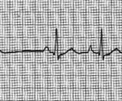 <p><span>premature atrial complex<br>caused by: caffeine, alcohol, nicotine, stretched atrial myocardium, hypervolemia, atria ischemia, infartion<br>No TX for infrequent<br>more than 6 per min is frequent and treat underlying cause</span></p><p><br></p>