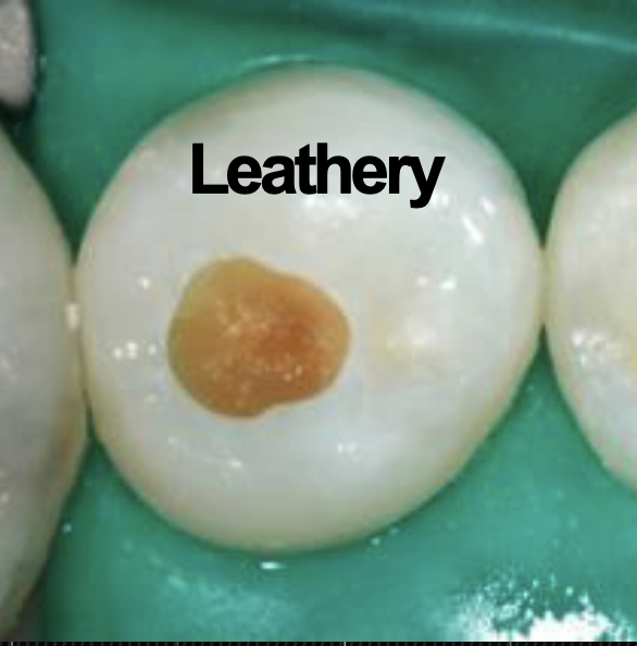 <p>Leathery Dentin</p><p>May be little difference between leathery and firm dentin, with leathery being a transition on the spectrum between soft and firm dentin</p>