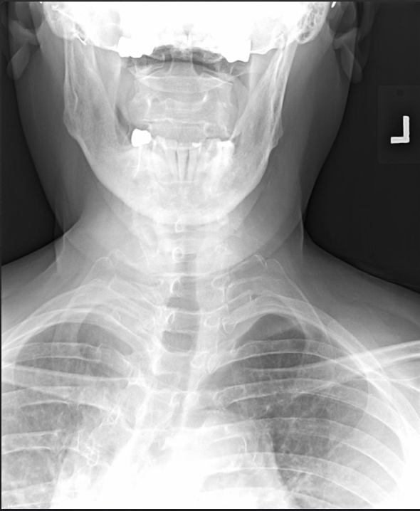 <p>Is this film of diagnostic quality (APOM Cervical)</p>