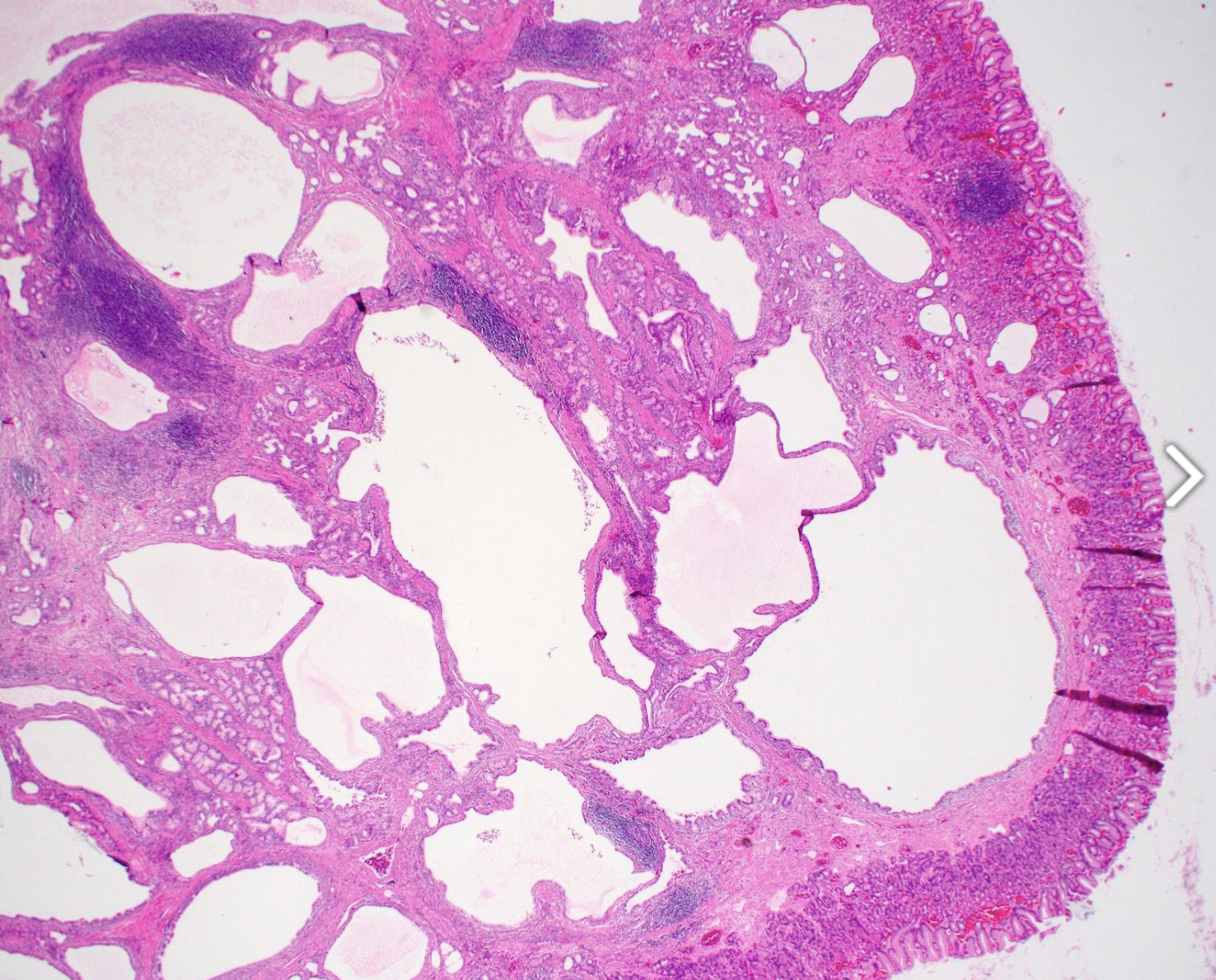 <p>Lésion polypoïde de l’estomac</p><p>1) diagnostic</p><p>2) définition</p>