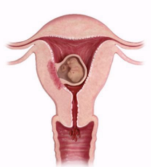 <ul><li><p><span style="background-color: transparent;">Bleeding, spotting, or cramping with a closed cervical OS</span></p></li><li><p><span style="background-color: transparent;">50/50 odds for normal outcome or spontaneous abortion</span></p></li><li><p><span style="background-color: transparent;">Clinical signs:</span></p><ul><li><p><span style="background-color: transparent;">No reliable signs</span></p><ul><li><p><span style="background-color: transparent;">More clinical than sonographic</span></p></li></ul></li><li><p><span style="background-color: transparent;">Vaginal bleeding < 20 weeks</span></p></li><li><p><span style="background-color: transparent;">Lower abdominal ache</span></p></li></ul></li></ul><p></p>