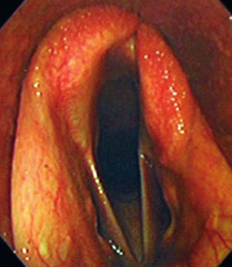 <p>A draft horse presents with inspiratory whistling and *roaring* during exertion. This horse has exercise intolerance and decreased athletic performance. On endoscopy you see this. Thoughts?</p>