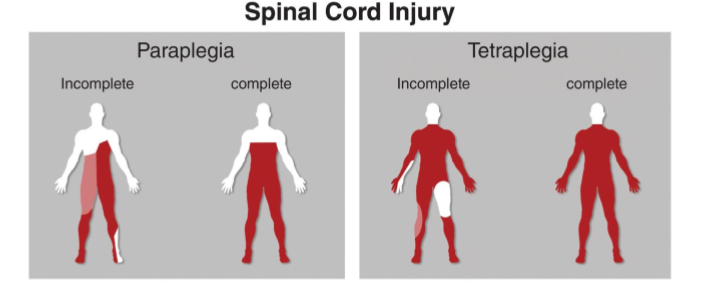 <p>Produce sensory, motor, and/or autonomic disfunction </p><ul><li><p>Complete vs. incomplete</p></li><li><p>Paraplegia vs. tetraplegia (quadriplegia)</p></li><li><p>Can be from direct trauma or vascular insufficiency</p></li></ul><p></p><p></p>