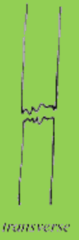 <p>fracture line at right angle to long axis of bone</p>