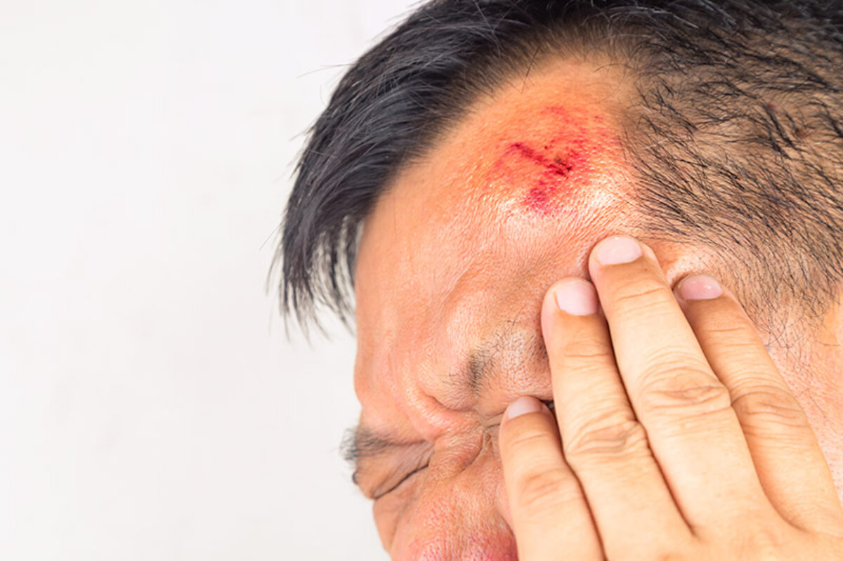 <p>What bandaging technique should be used for this injury?</p>