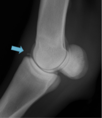 <p>What is the etiology of metacarpophalangeal joint osteochondral fragments in horses?</p>