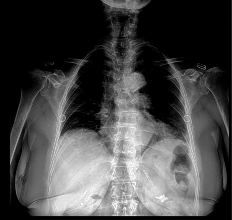 <p>Is this film of diagnostic quality (AP Thoracic)</p>