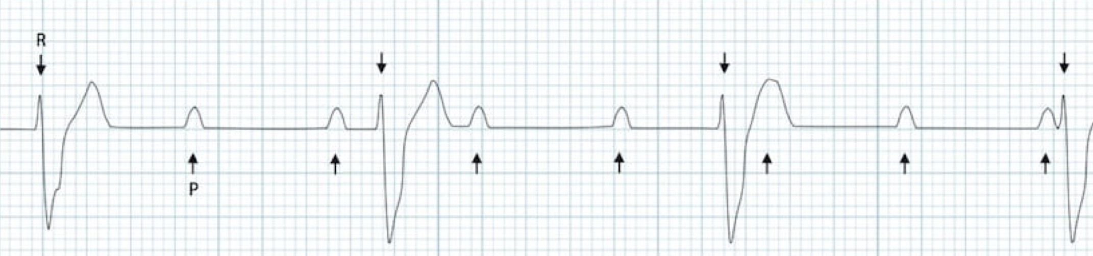<p>What rhythm/abnormality is seen below?</p>