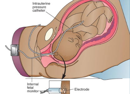 <p><span style="line-height: 20px;"><span>Most precise method to monitor FHR &amp; contractions&nbsp;</span></span></p><ul><li><p class="Paragraph SCXW258236004 BCX2" style="text-align: left;"><span style="line-height: 20px;"><span>Pass a pressure-sensing catheter through the vagina and into uterus after membranes ruptured, SCREW TO BABY HEAD</span></span></p></li></ul><p></p>