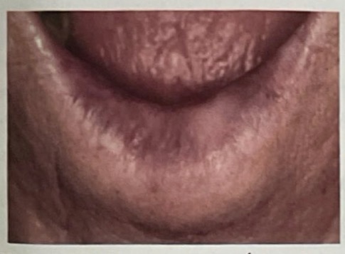 <p>BN 50y</p><p>XUẤT HIỆN TỔN THƯƠNG Ở MÔI DƯỚI</p><p>CHẨN ĐOÁN</p>