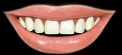 <p>What is gingival display?</p>