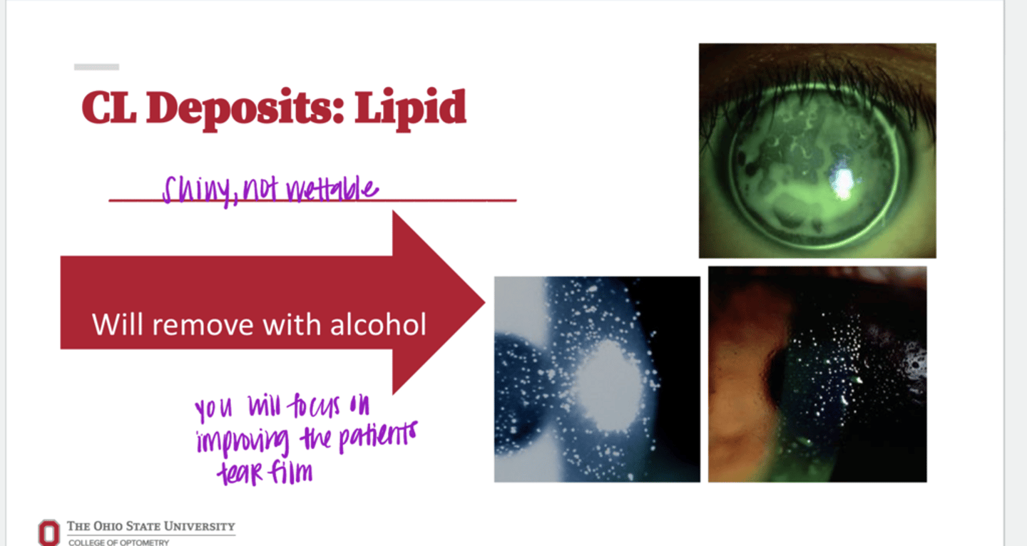 <p>What is the appearance of lipid deposits on a CLs?</p>
