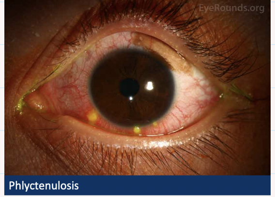 <ul><li><p>Type 4 hypersensitivity reaction </p></li><li><p>Associated with systemic disorders → Bechets disease, TB, rosacea </p></li><li><p>Phylcten in cornea or conjunctiva </p></li><li><p>conjunctival → inflamed nodules</p></li><li><p>Cornea → grey nodules </p></li></ul><p></p><ul><li><p>TX = topical steroids </p></li></ul><p></p>