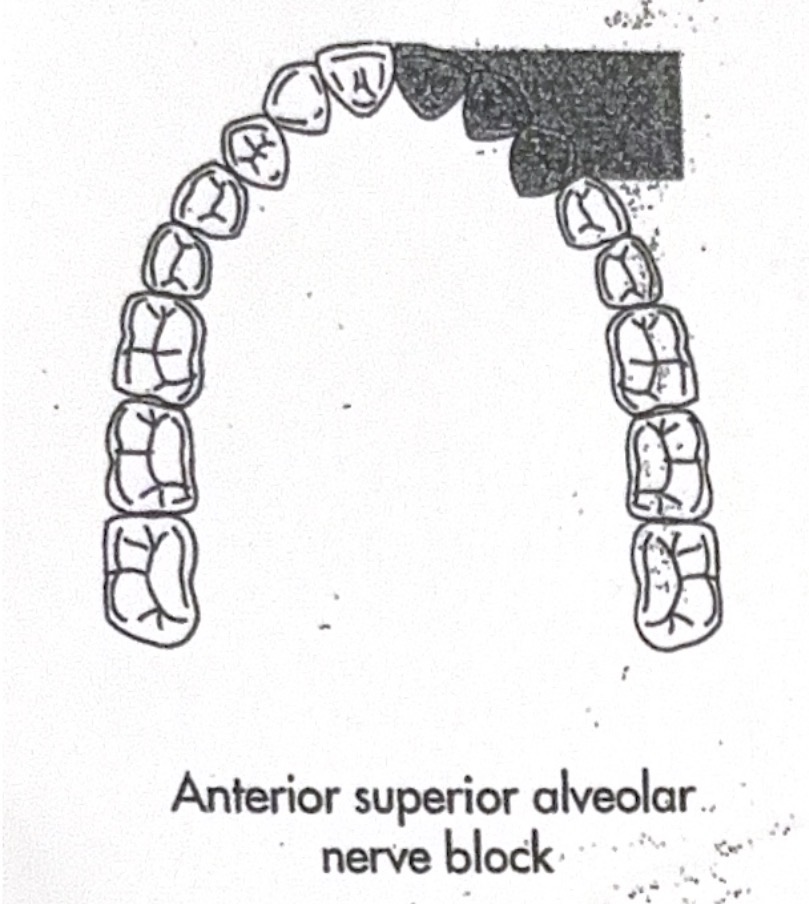 <p>mucobuccal fold at apex of maxillary canine</p>