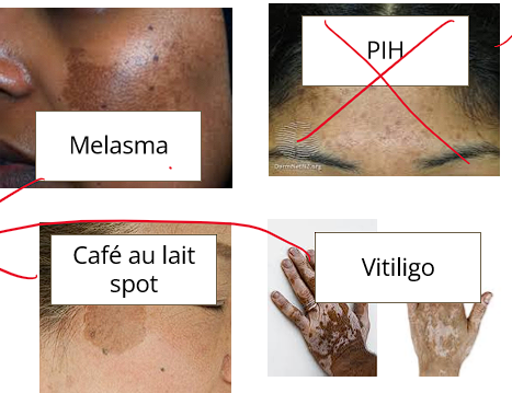 <ul><li><p>vitiligo</p></li><li><p>cafe au lait spot</p></li><li><p>tinea versicolor</p></li><li><p>melasma</p></li></ul><p></p>