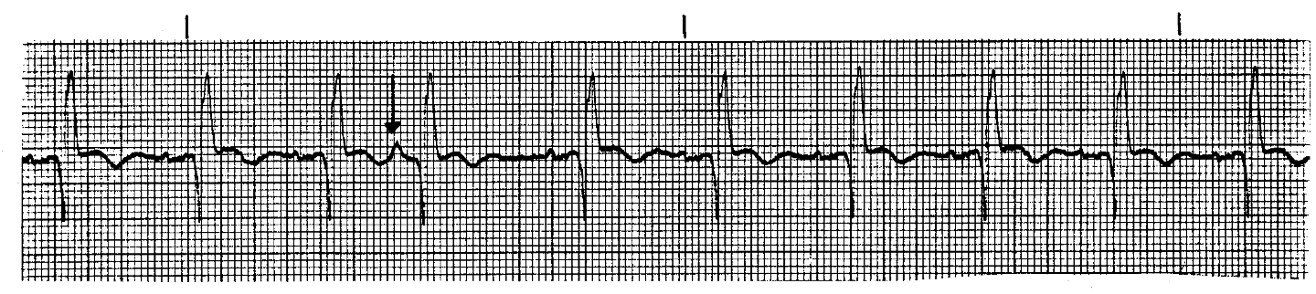 <p>What ECG is this? </p>