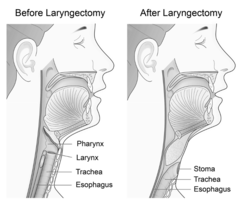<p>surgical removal of the larynx</p><p>complications: airway obstruction, aspiration, infection, scar tissue stenosis, mucus obstruction</p>